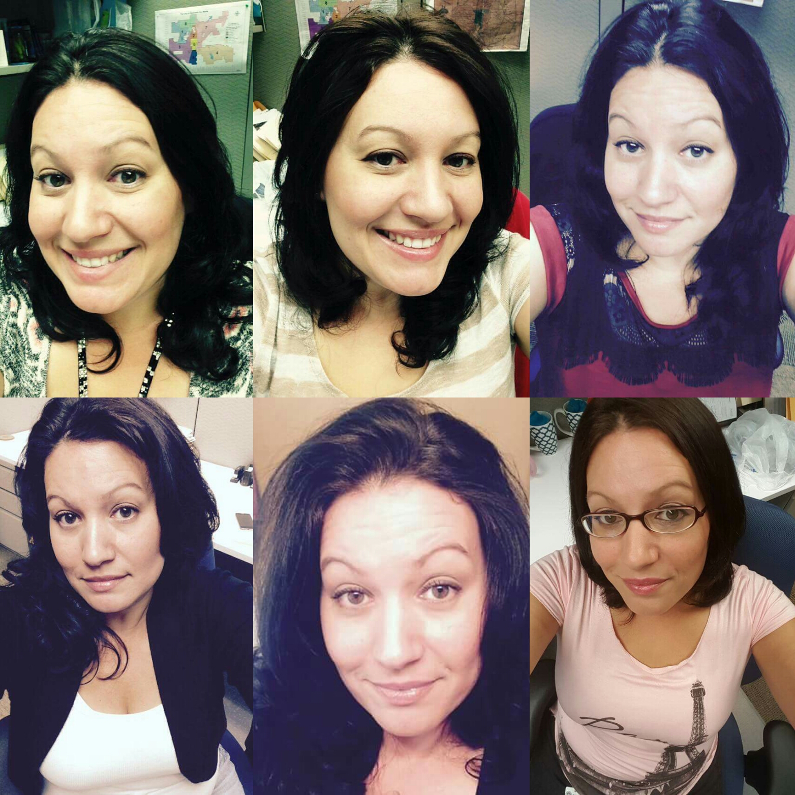 Hypothyroid in photosBefore and After Stop The Thyroid Madness