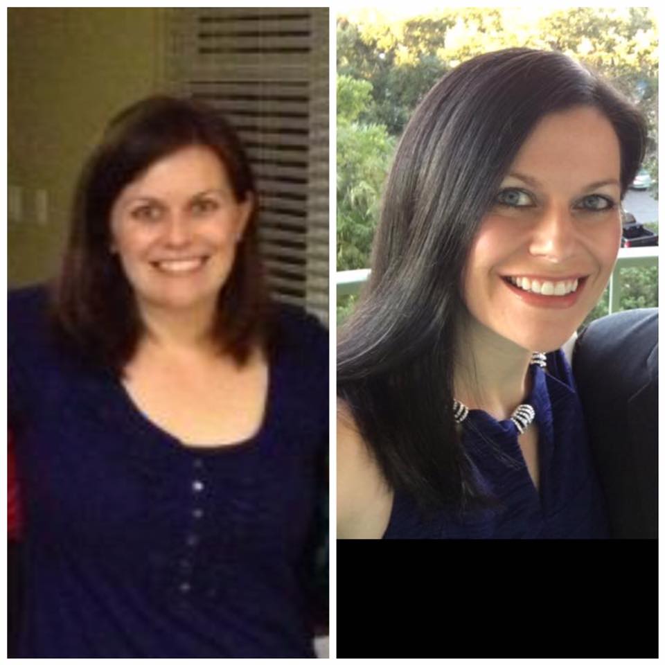 Hypothyroid In Photos Before And After Stop The Thyroid Madness