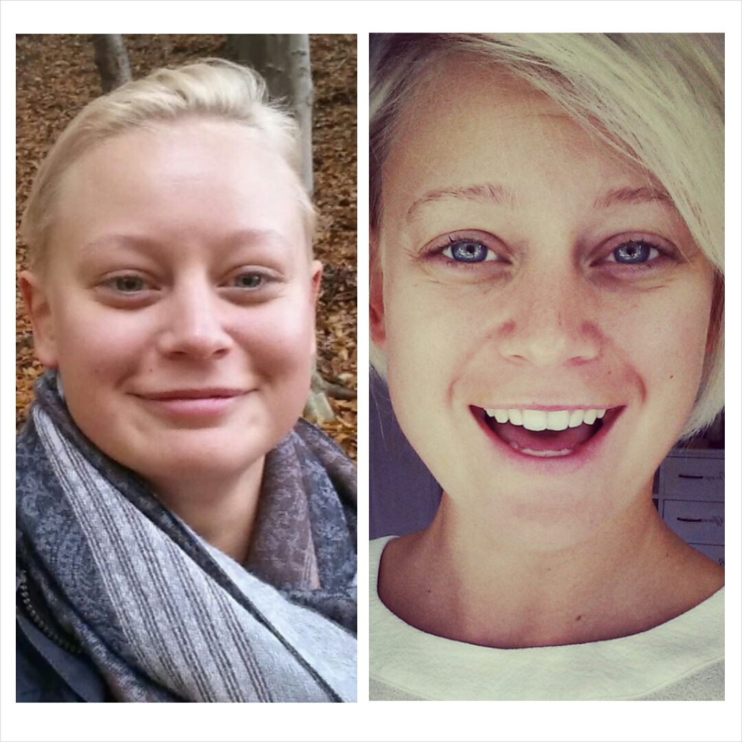 Hypothyroid In Photos Before And After Stop The Thyroid Madness hypothyroid-in-photos-before-and-after-stop-the-thyroid-madness